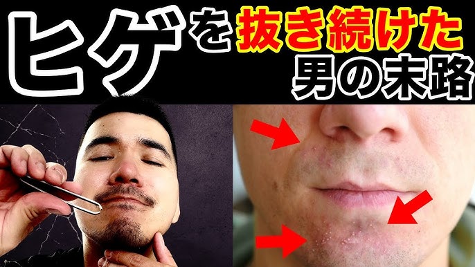 ヒゲを毛抜きで抜くのは危険！起こりうる肌トラブル4つと「生えなくなる」噂の真相 | ツルオ