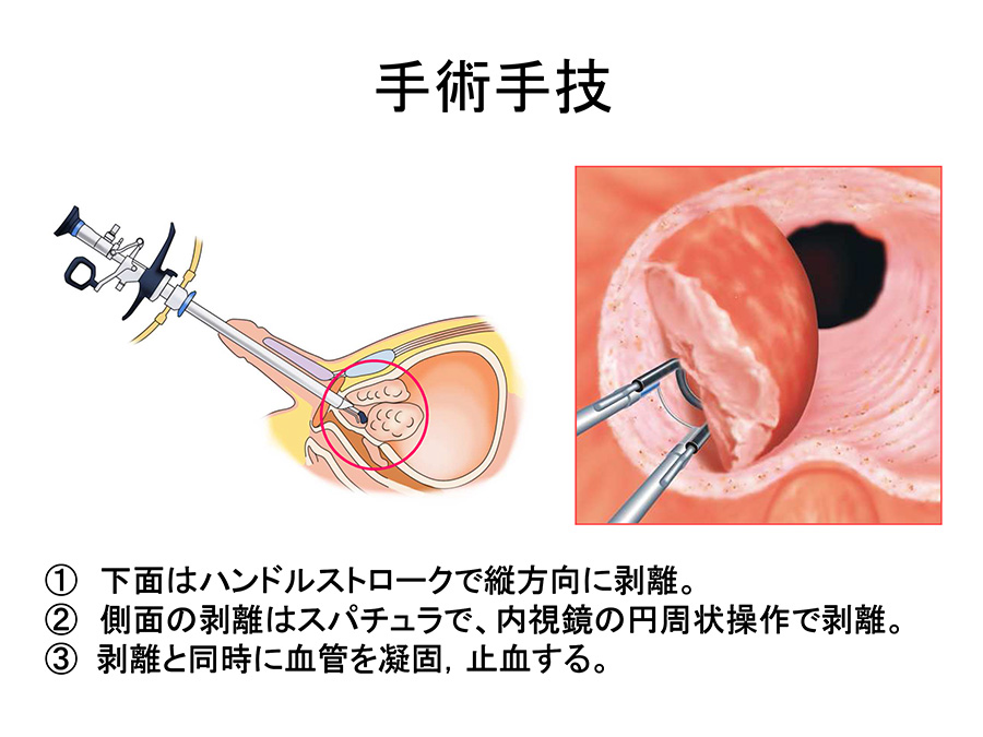 前立腺肥大症に対する経尿道的前立腺手術(HoLEP、TUR-P) - 島田市立総合医療センター