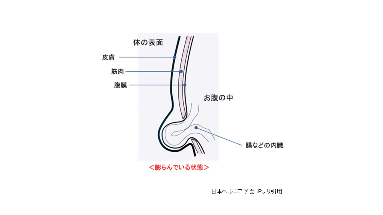 奈良市の鼠径部の膨らみしこりでお困りの方へ - 大阪うめだ鼠径ヘルニアMIDSクリニック（そけいヘルニア専門サイト）