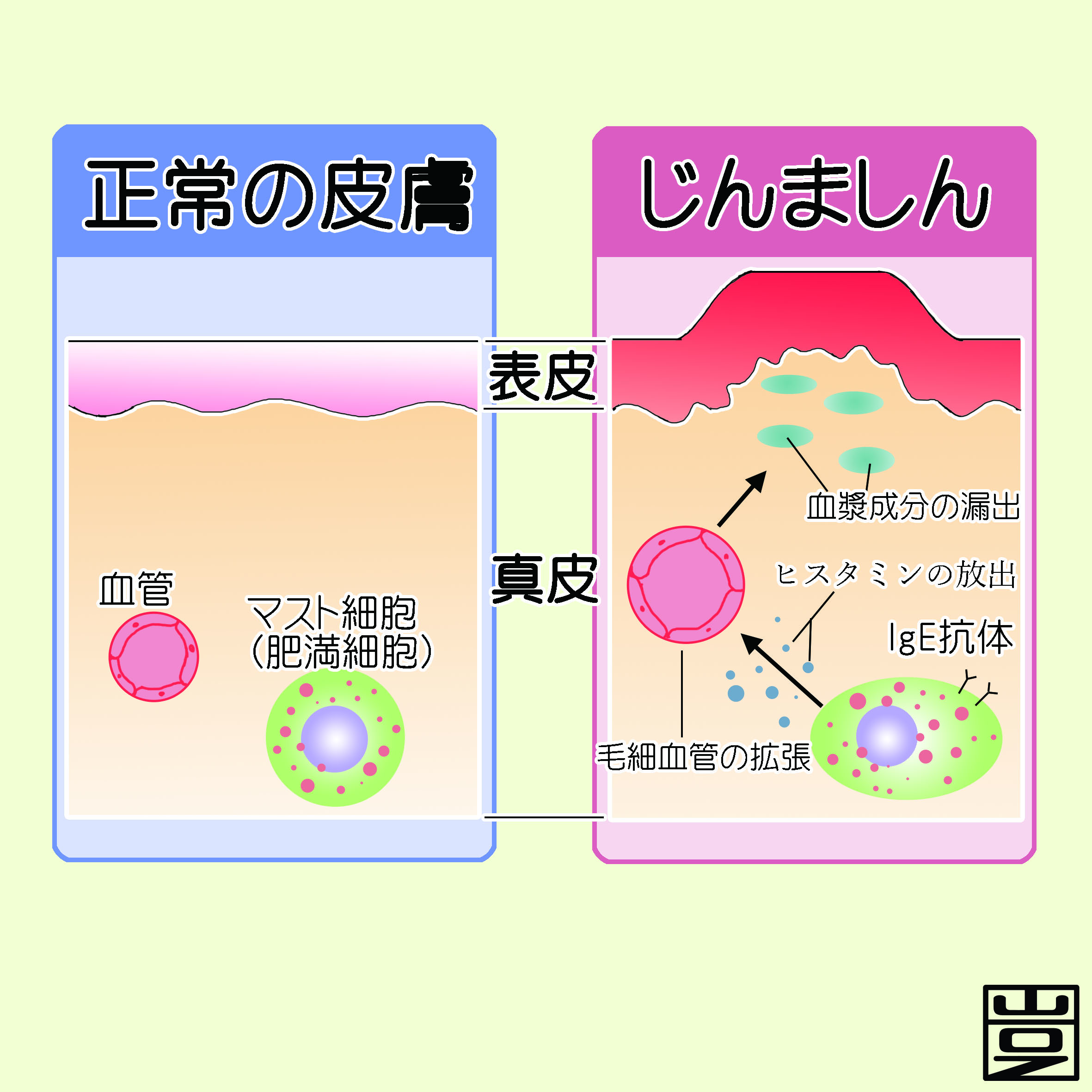 デリケートエリアにステロイド外用剤（塗り薬）は使える？｜薬局・薬店で相談できる皮膚トラブル｜ヒフシルワカル