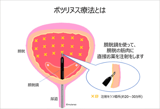 泌尿器科先端治療のご案内 | 泌尿器科 |