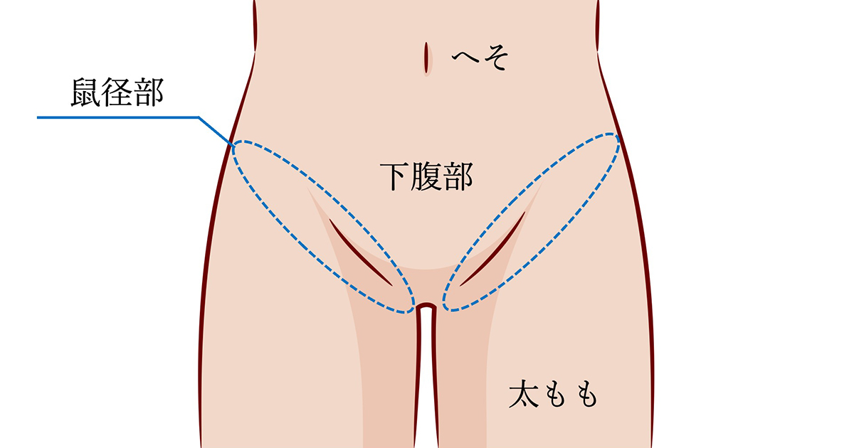 亀頭・陰茎のブツブツ除去｜MSクリニック