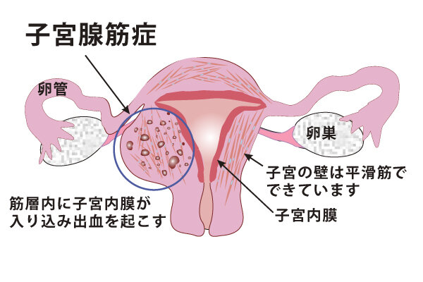 PMS(月経前症候群)とは｜命の母｜小林製薬