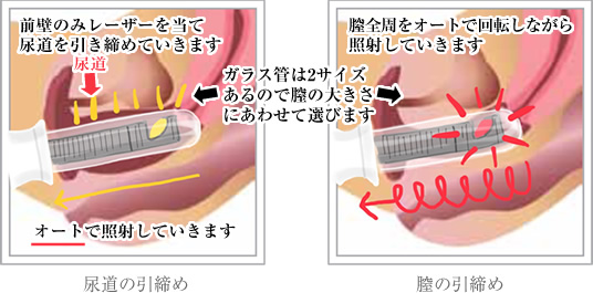 尿道形成術とは？｜尿道狭窄症・尿道形成術の医師堀口明男