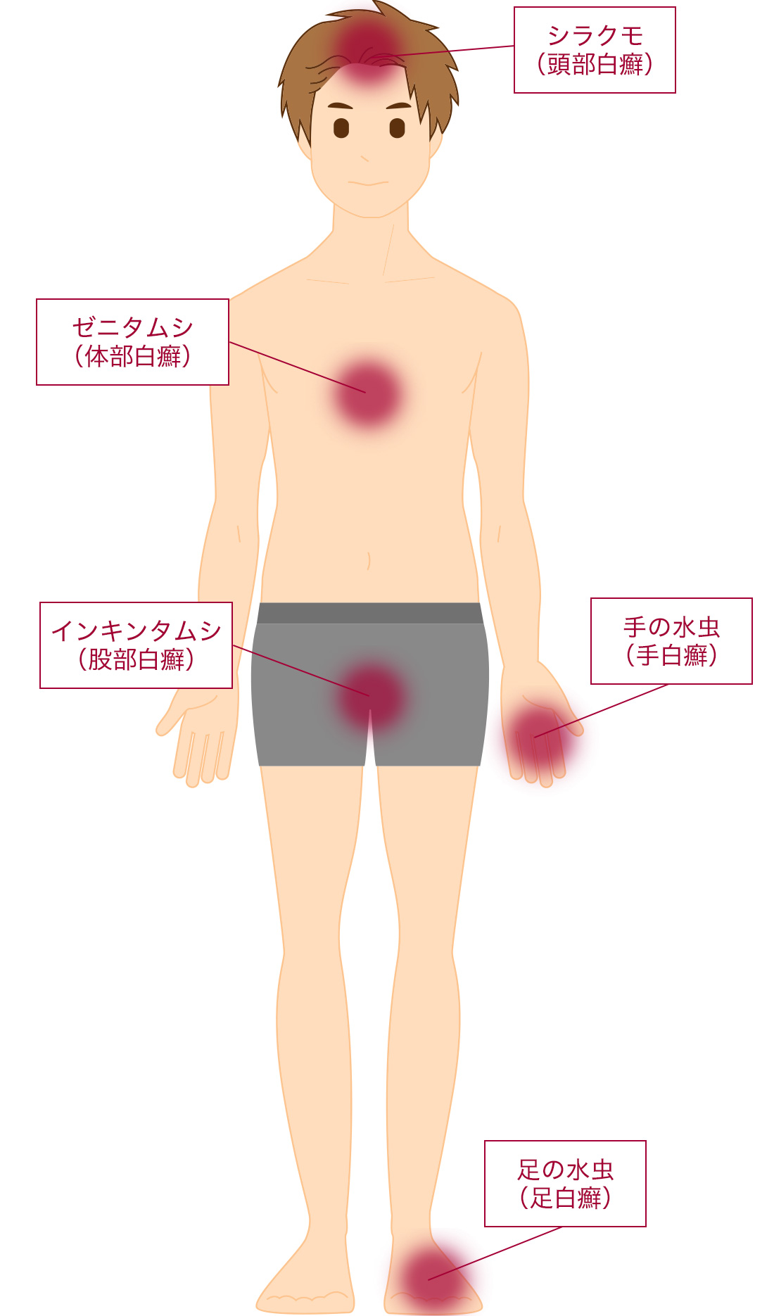 新レスタミンｺｰﾜ軟膏｜コーワ健康情報サイト｜KOWA