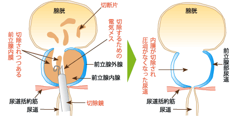 経尿道的水蒸気治療(WAVE)