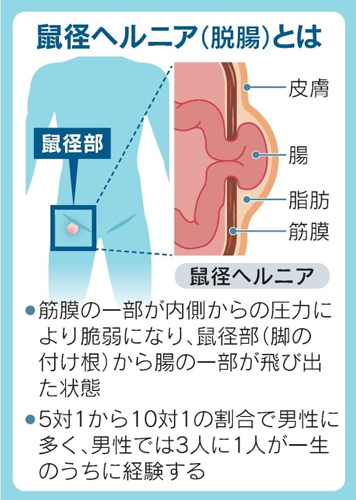 グロインペイン症候群（鼠径部痛症候群） - カテーテル治療で痛みを改善