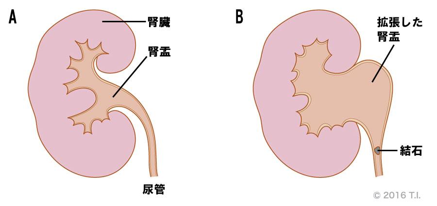 人工尿道括約筋埋込み術について | 国立がん研究センター