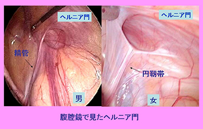 千葉県で鼠径ヘルニア・脱腸を治療｜Kenクリニック