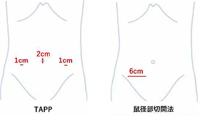 鼠径ヘルニア | 緑区・天白のさくら医院|消化器内科・胃腸科・健康診断