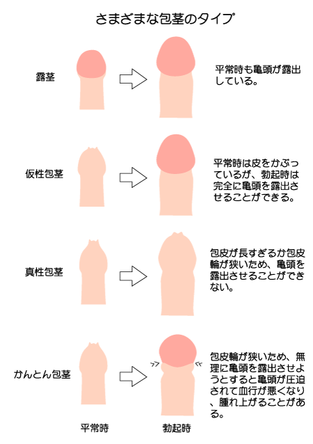 皮を剥くってどこまで？」男児のむく・むかない問題の曖昧さ【医師に聞く】｜CHANTO WEB