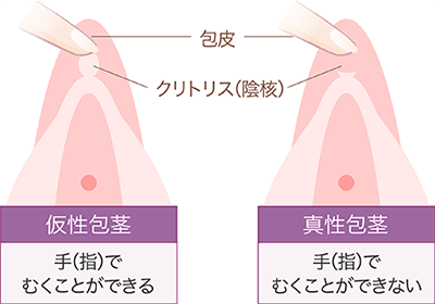 これでクリトリスのすべてが分かる！ 腫れ・かゆみ問題の対処法に専門家がアンサー