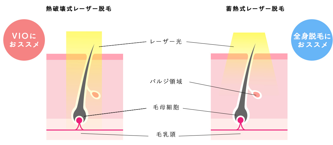 VIO医療脱毛｜群馬県高崎市・太田市・前橋市・伊勢崎市・桐生市・館林市・渋川市・藤岡市・安中市のVIO脱毛